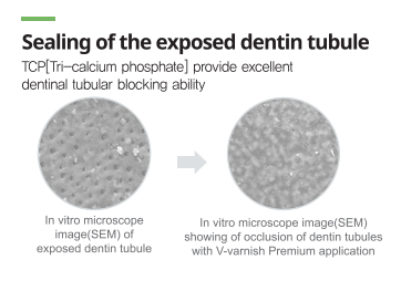 V-varnish Premium - 5% sodium fluoride, TCP and xylitol